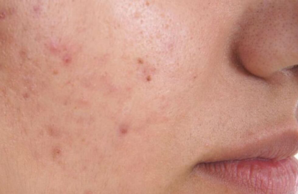 En mayo comienza la campaña "Primavera sin acné"