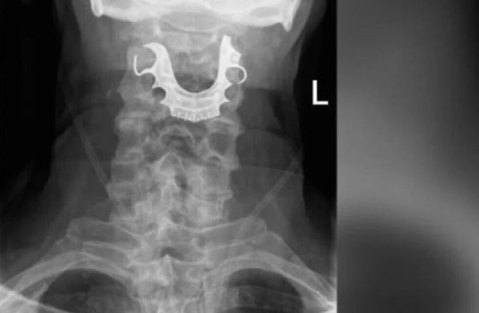 Un hombre tuvo la dentadura postiza atorada ocho días en la garganta tras una operación