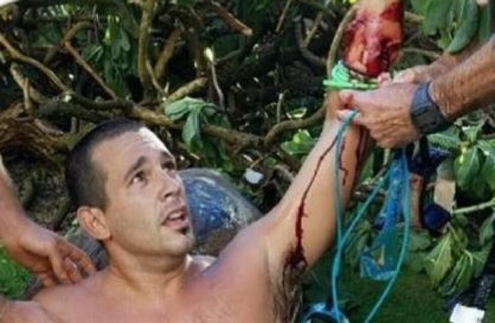Un tiburón atacó a un surfer argentino en Hawai y debieron operarle el brazo