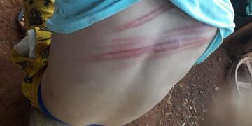 Quevedo mostró las marcas que le dejaron en el cuerpo tras la agresión\u002E