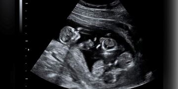 Nacieron trigemelas en Santa Rosa (Web)