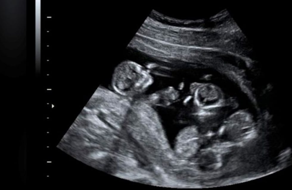 Nacieron trigemelas en una cesárea en la Clínica Modelo de Santa Rosa