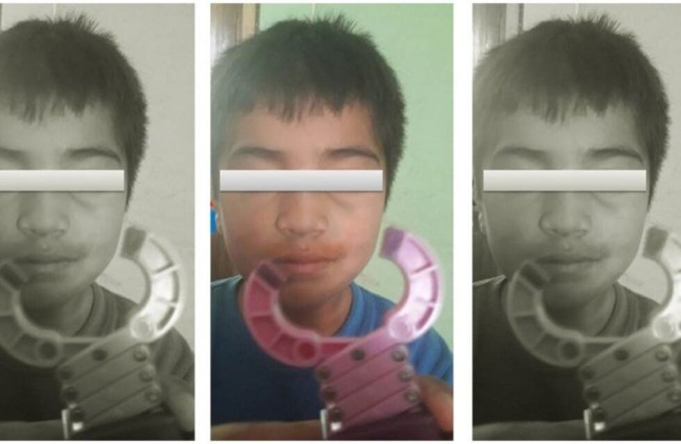 Le rompieron el tabique a un niño de 4 años en el jardín