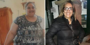 Lourdes Páez de 31 años a la Unidad de Pacientes Obesos y fue operada este miercoles