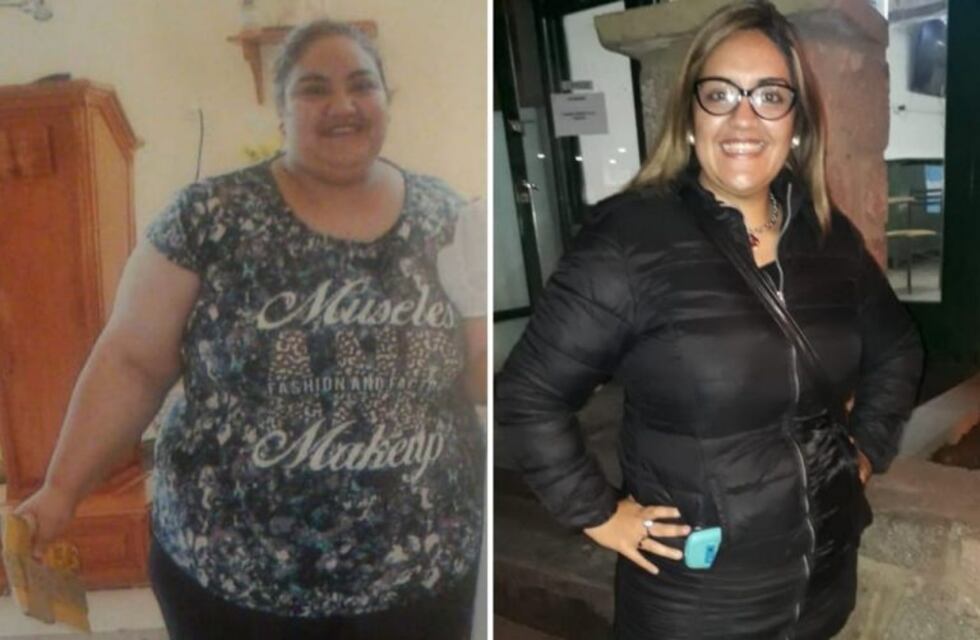 Se realizó en La Rioja la primera cirugía bariátrica en un hospital público del Noroeste