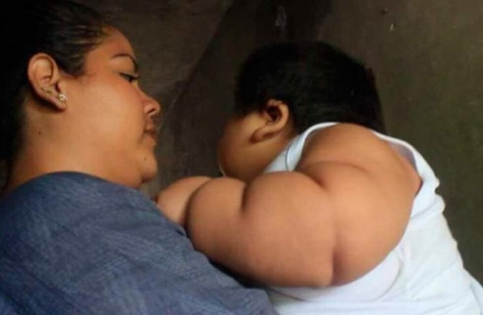 El caso del bebé que tiene 10 meses y pesa 28 kilos