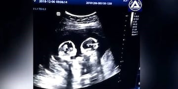 Gemelas son captadas a las piñas por un ultrasonido