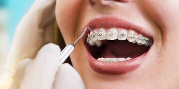 Tratamiento de ortodoncia\u002E