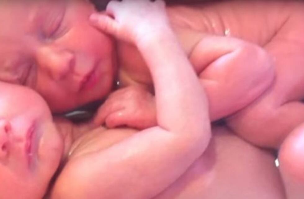 Cómo son los gemelos casi idénticos que se consideran únicos