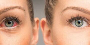 Campaña de prevención del glaucoma\u002E