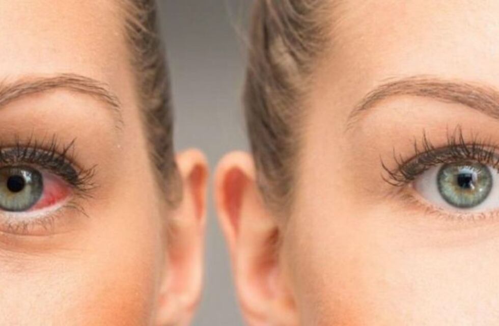 Campaña nacional de prevención de ceguera por Glaucoma