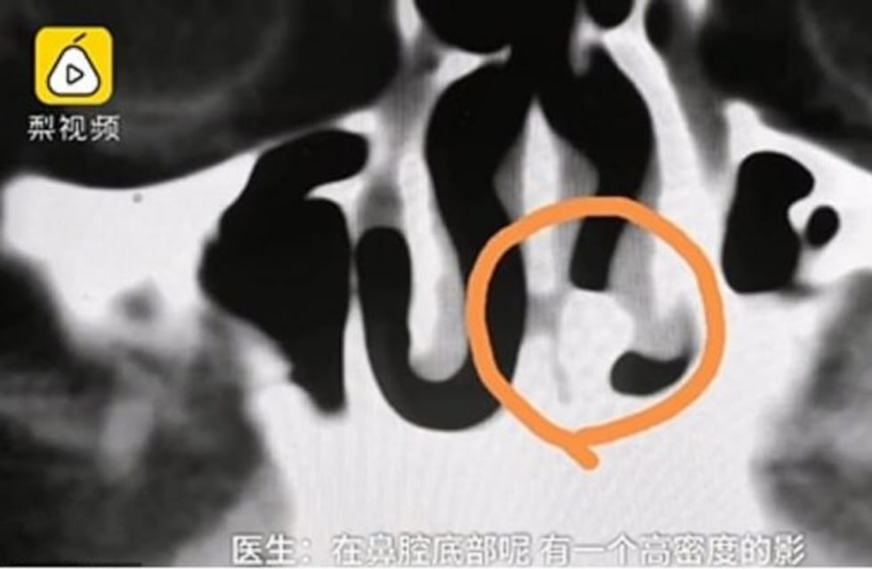 Fue al médico por una molestia en la nariz y le encontraron un diente que llevaba 20 años creciendo