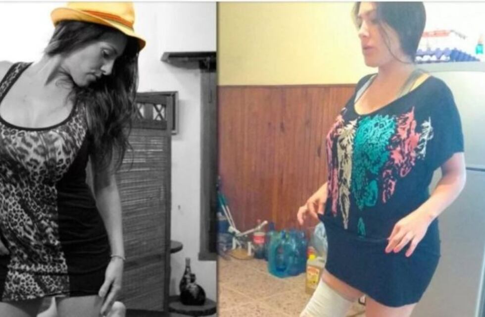 Se hizo una liposucción y terminó con una pierna amputada