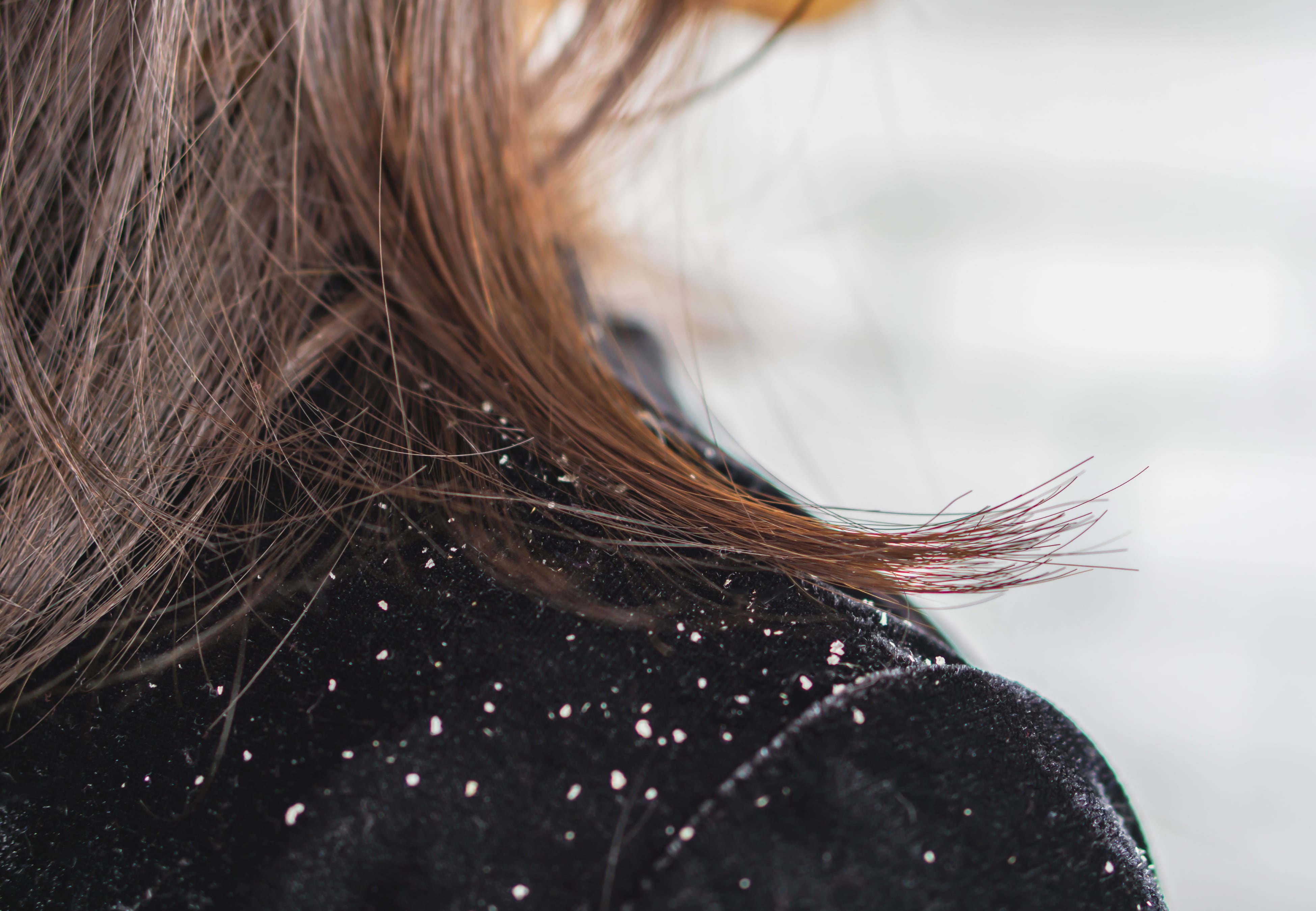 Cómo eliminar la caspa del pelo.