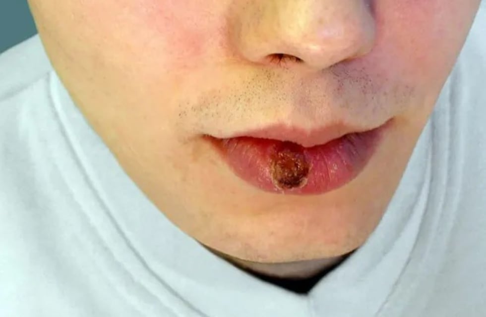 Alarmante aumento de casos de sífilis