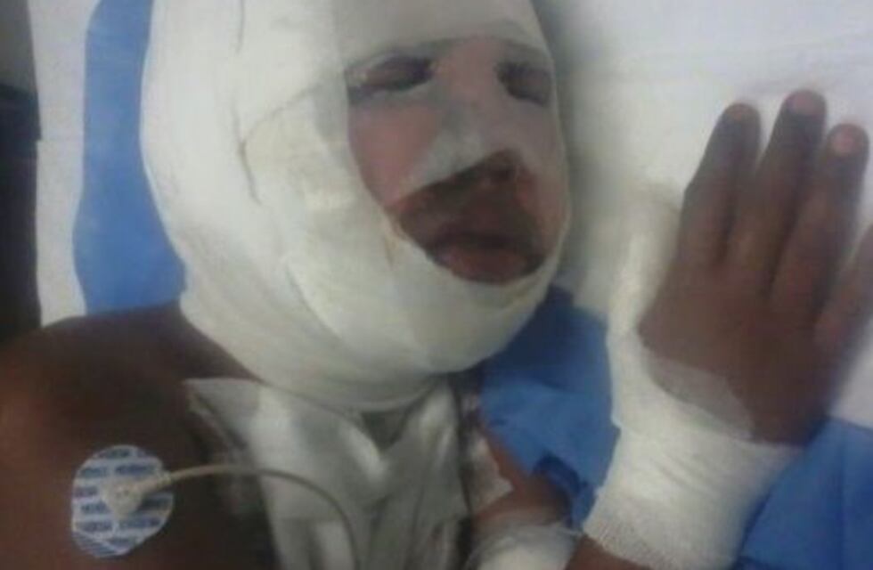 Un niño de 9 años está internado con quemaduras profundas por pirotecnia