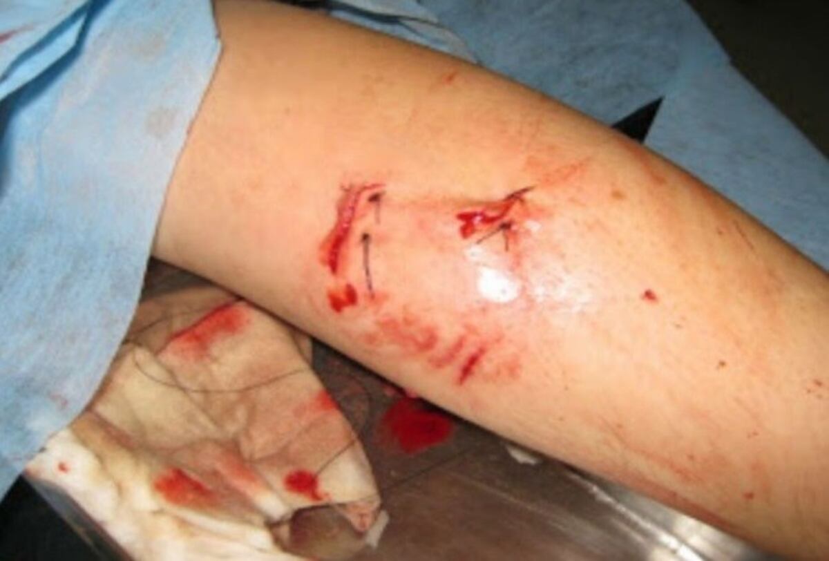 El sujeto golpeó, amenazó de muerte a su pareja y además la mordió en una pierna\u002E