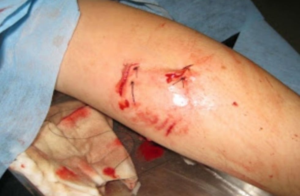 Golpeó, pateó y mordió a su pareja en una pierna