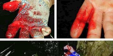 Los cortes y heridas son constantes en el trabajo de los recolectores\u002E