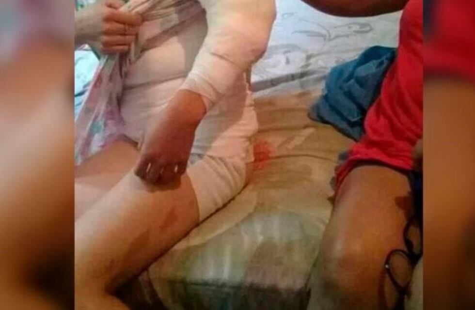 La expareja de una joven la roció con alcohol y la prendió  fuego