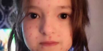 Lily Schooley, una niña inglesa de seis años, quiso evitar un examen y se pintó manchas rojas en la piel con marcador permanente