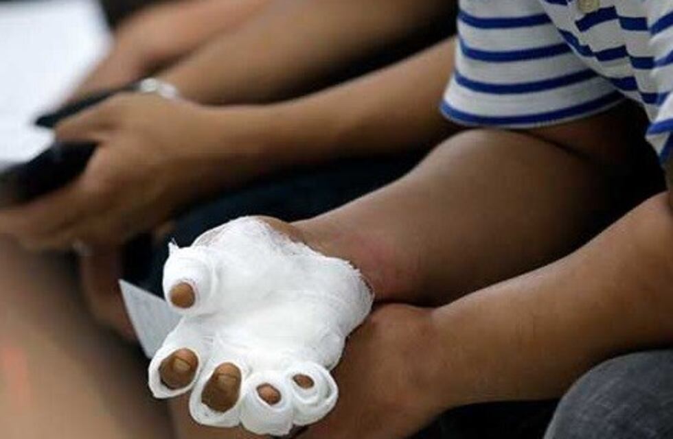 San Juan: un adulto y un menor con quemaduras leves por pirotecnia, el saldo de Nochebuena