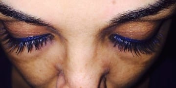 Badiaa Zahri se sometió a una rinoplastía pero salió mal y terminaron amputándole parte de la nariz