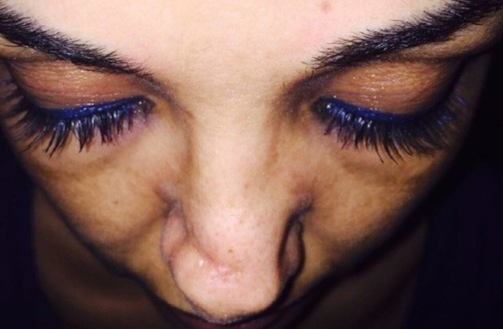 Se sometió a una rinoplastía pero salió mal y terminaron amputándole parte de la nariz