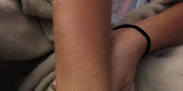 Semana del lunar en el Hospital San Roque