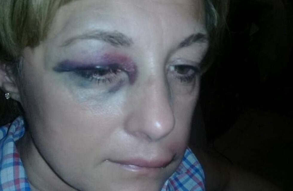 Le molieron la cara a golpes a una enferma de cáncer: le llevaron hasta la plata para la peluca