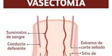 Vasectomía web