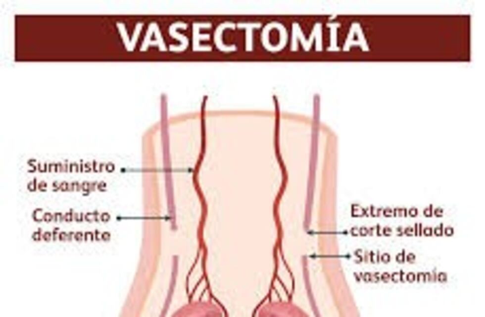 Aumentan las vasectomías de jóvenes en un hospital de Posadas