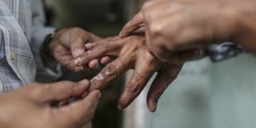 Imagen ilustrativa de paciente con lepra