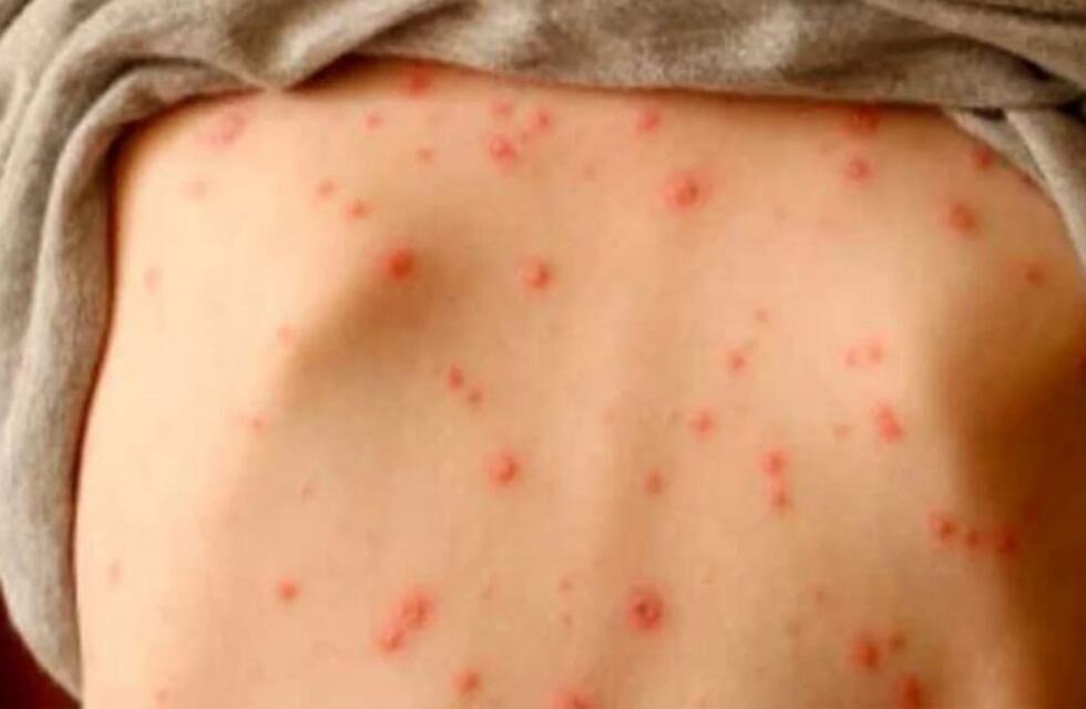 Alarmante brote de Sarampión y preocupación por los resultados de la campaña de vacunación