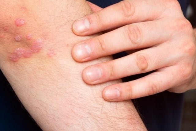 Lesiones de psoriasis que se atienden en consultorios del Hospital Madariaga\u002E