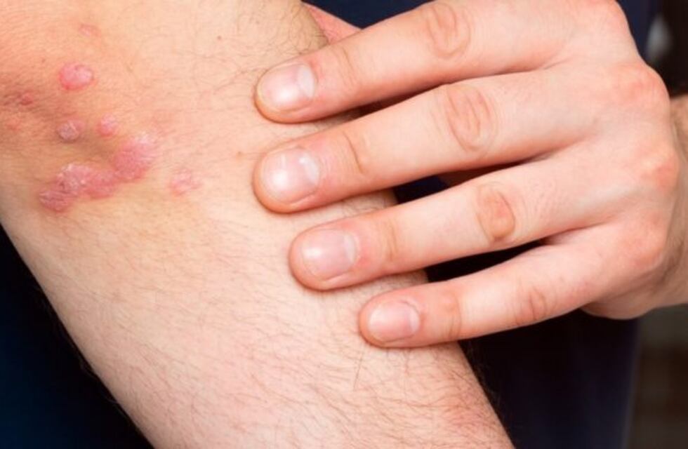 El Hospital Madariaga tiene un consultorio para la atención integral de pacientes con psoriasis