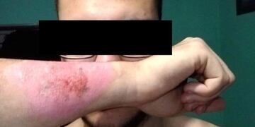 Se borró el tatuaje con un rallador de queso\u002E