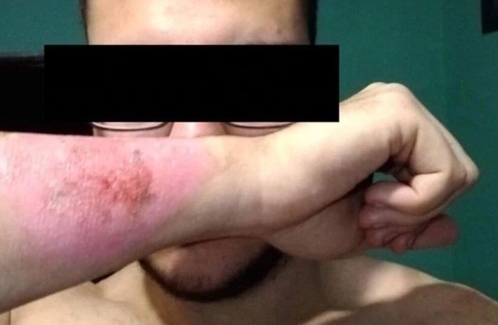 Se arrepintió del tatuaje y se lo borró con un rallador de queso