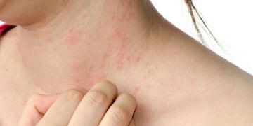 El Hospital Córdoba lleva adelante una campaña gratuita de detección de psoriasis\u002E