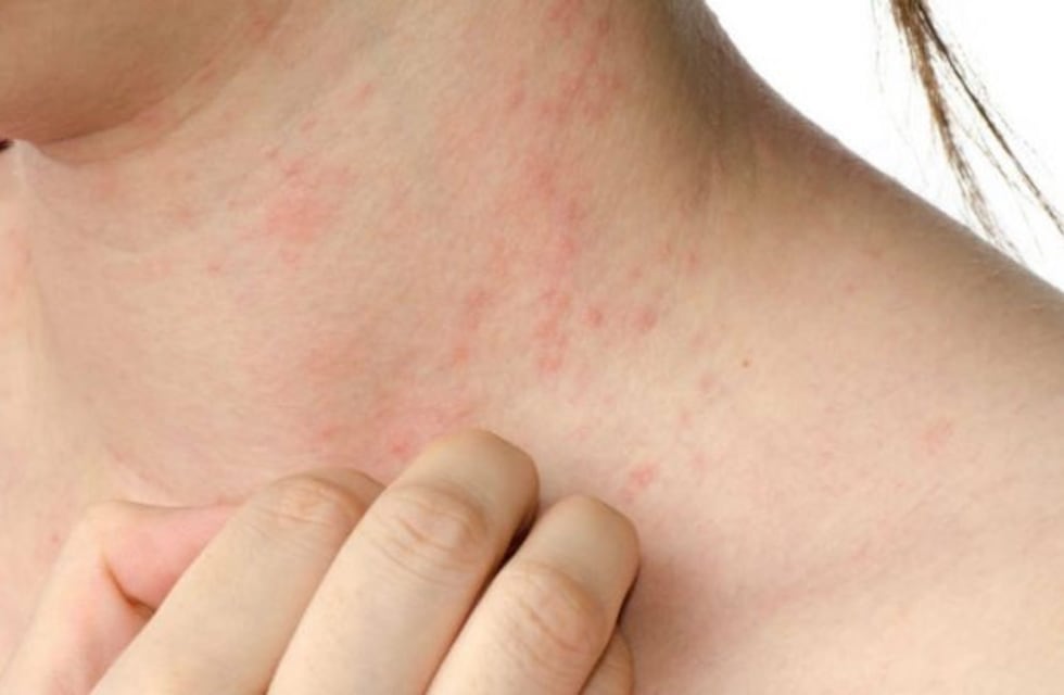 El Hospital Córdoba hará campaña de detección gratuita de Psoriasis y artritis psoriásica