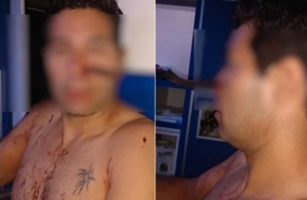 Le clavó un cuchillo en la nariz a la pareja de su ex al verlos entrar a un motel