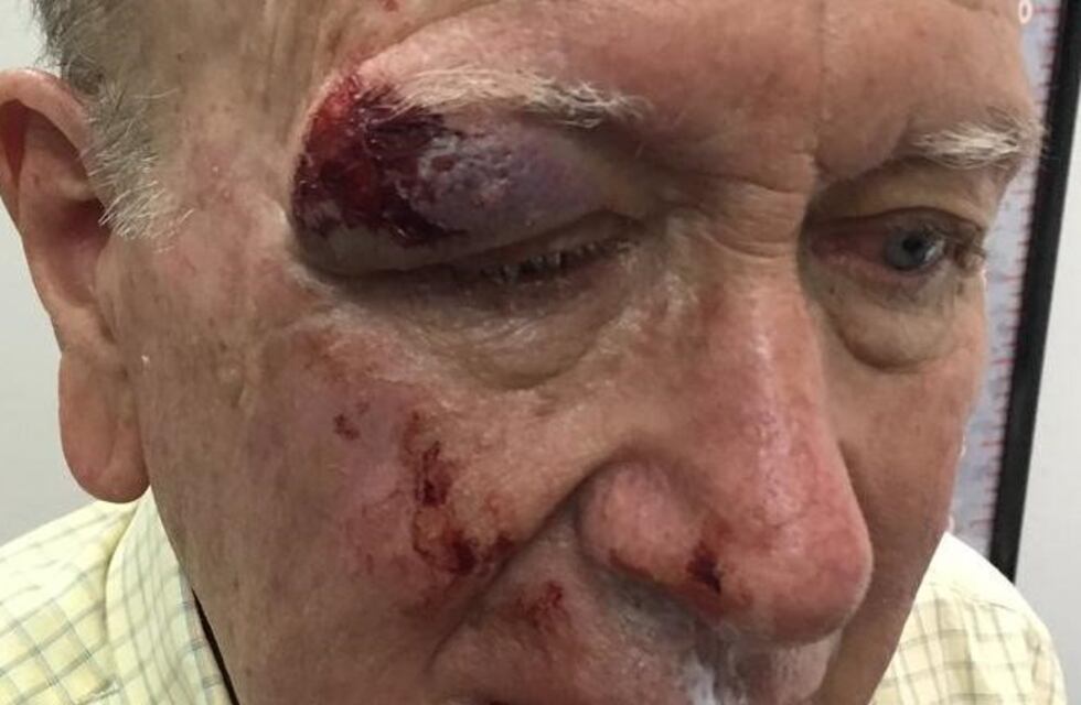 Tiene 87 años y lo desfiguraron por robarle $500