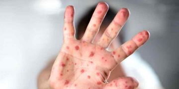 El Ministerio de Salud informó un "posible caso" de sarampión y emitió alerta epidemiológico