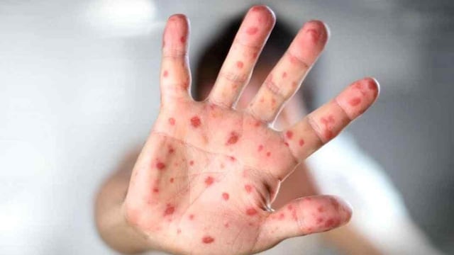 El Ministerio de Salud informó un "posible caso" de sarampión y emitió alerta epidemiológico