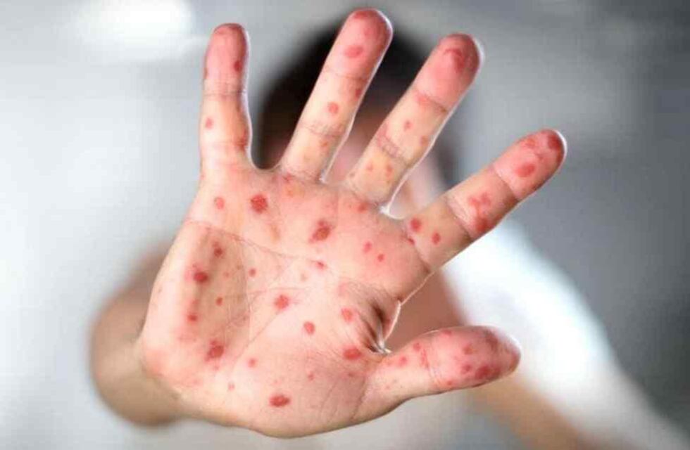 El Ministerio de Salud informó un “posible caso” de sarampión y emitió alerta epidemiológico