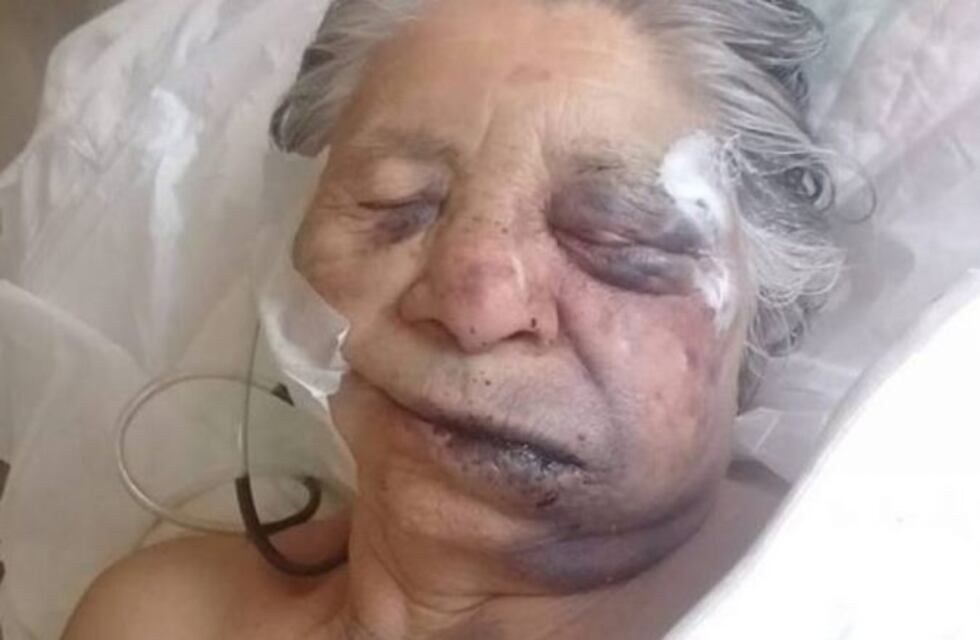 Le fracturaron el cráneo y la desfiguraron a una abuela de 84 años en una entradera