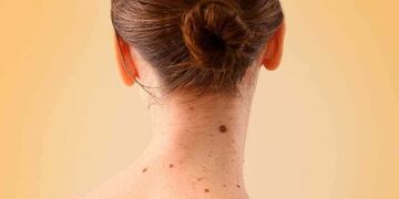 Consultas dermatológicas en verano (Web)