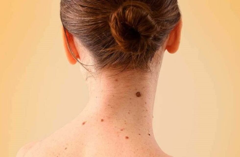 Bajaron las consultas para detectar el cáncer de piel por miedo al coronavirus