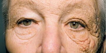 Caso McElligott: sufrió el envejecimiento en una parte de la cara tras 28 años como camionero