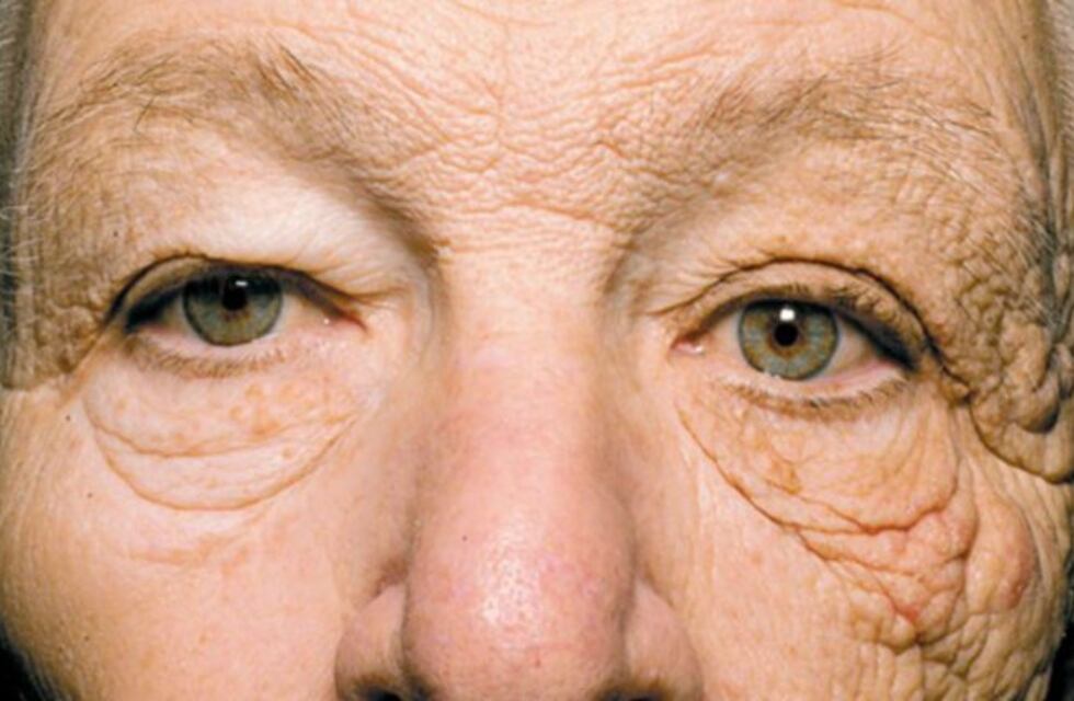 Caso McElligott: sufrió el envejecimiento en una parte de la cara tras 28 años como camionero